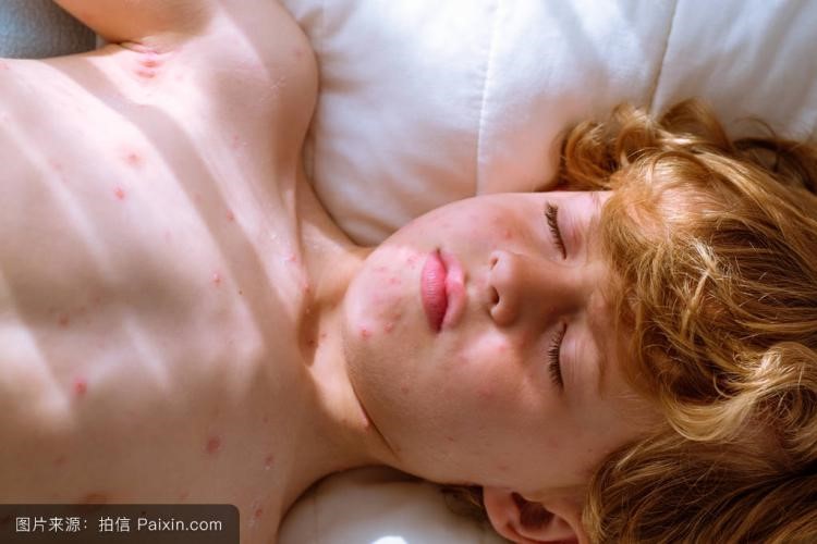 刚满月的宝宝是不是不容易生病,没满月的宝宝会出水痘吗