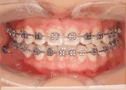 牙齿矫正得越快价格会越便宜吗,年龄越小牙齿矫正越快吗