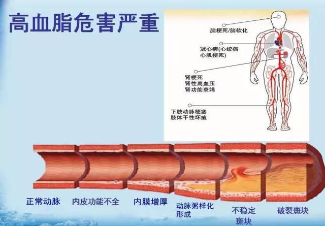 高血脂医学上叫什么,带你了解妊娠期高血脂症