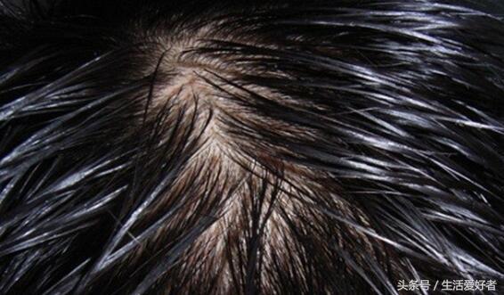 儿童脱发吃点什么头发长得快,脱发严重怎么快速长头发