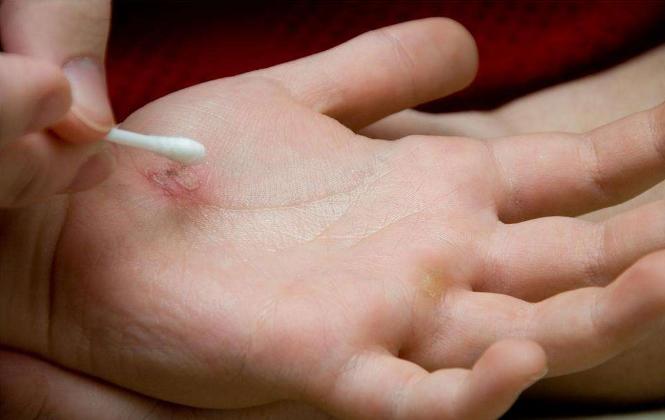 皮肤伤口难愈合是什么原因,皮肤伤口难愈合还很痒是什么原因