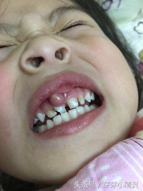 牙龈处长了不疼的小包,牙龈上起了一个小肉包的图片