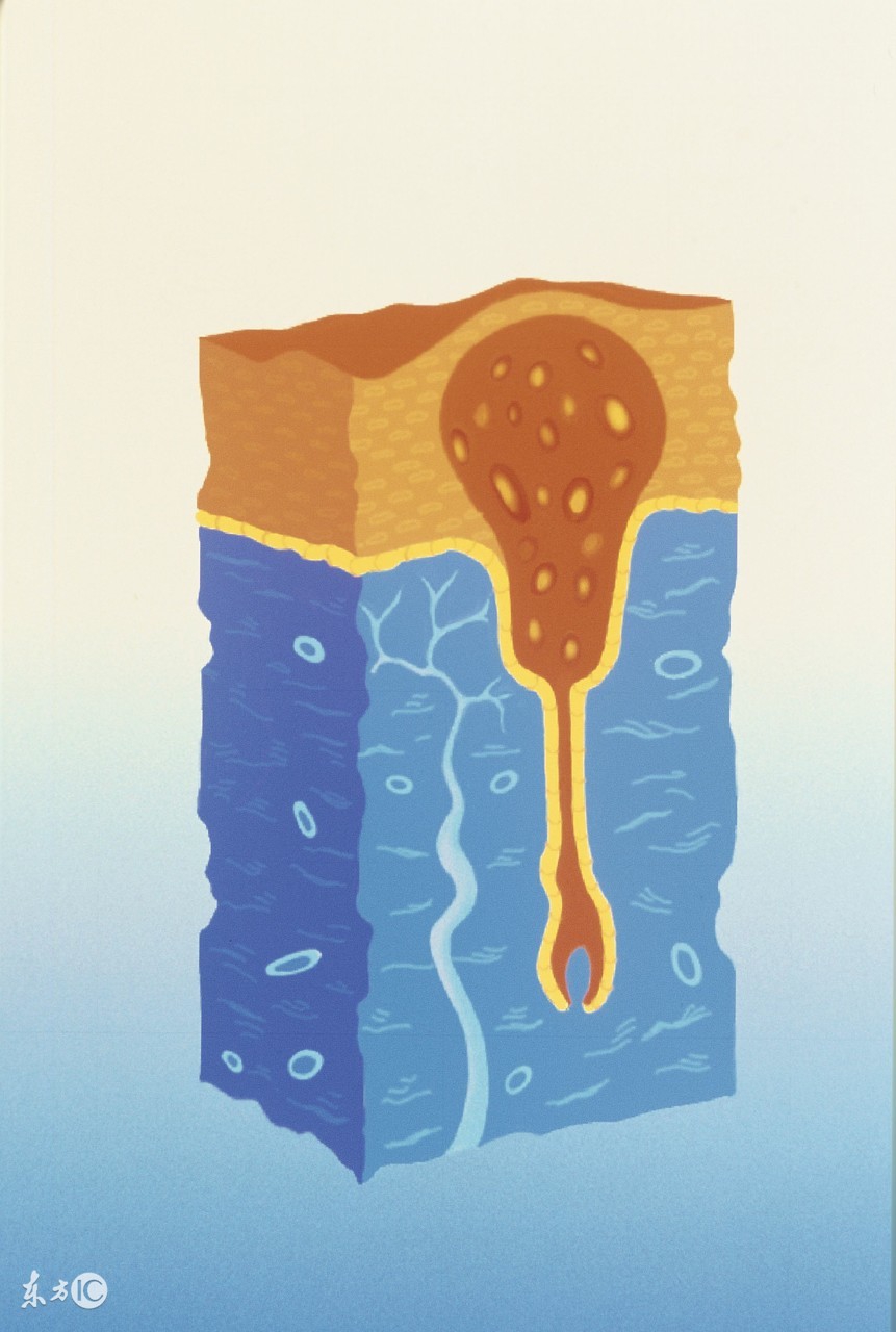 如何通过饮食来治疗毛囊炎呢