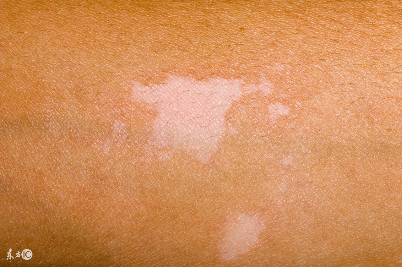 得了白癜风如何防止白斑扩散,白癜风在治疗还扩散怎么办