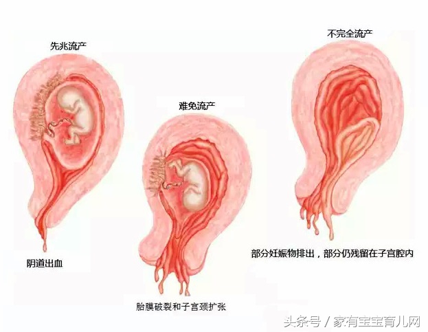 流产后又怀孕能再次流产吗,流产影响下一胎吗