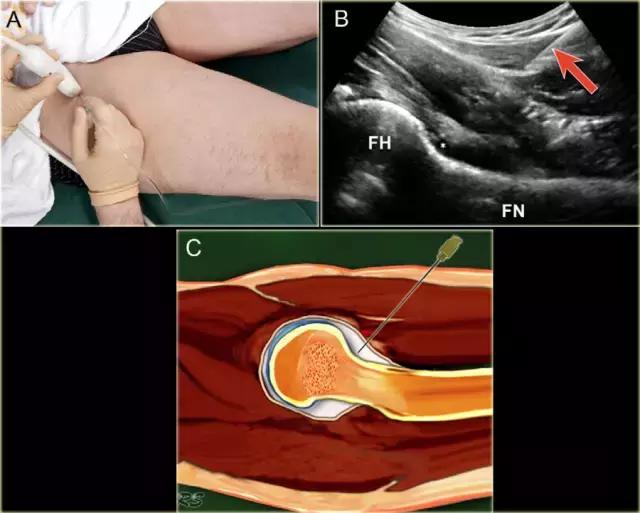 超声引导下穿刺手法解析,超声介入穿刺和普通穿刺的区别