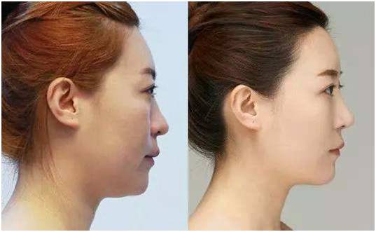 玻尿酸是瘦脸还是填充,玻尿酸填充脸颊会有提拉效果吗