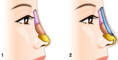 膨体隆鼻和硅胶哪个更好,膨体和硅胶哪种隆鼻最安全永久