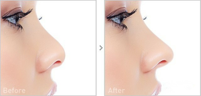 线雕隆鼻是什么意思,线雕隆鼻有什么危害吗有副作用吗