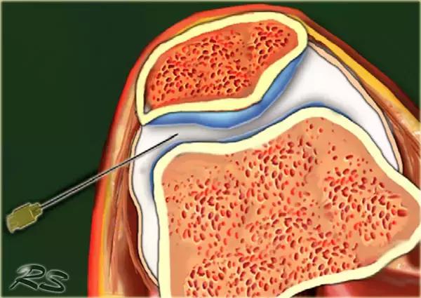 超声引导下穿刺手法解析,超声介入穿刺和普通穿刺的区别