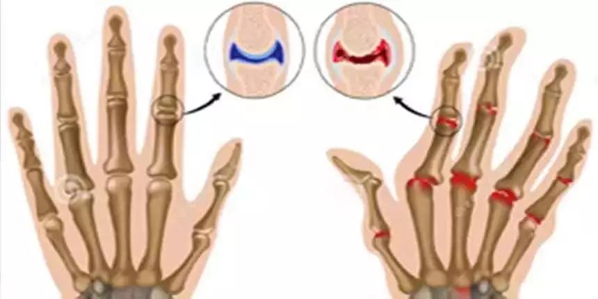 穿好奶奶织的毛裤，你仍然无法避免与风湿膏药共度晚年