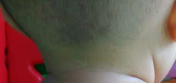 宝妈胎记,胎记你们的宝宝有吗