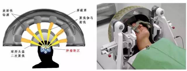 国药东风医院放疗设备,放疗最先进的放疗设备