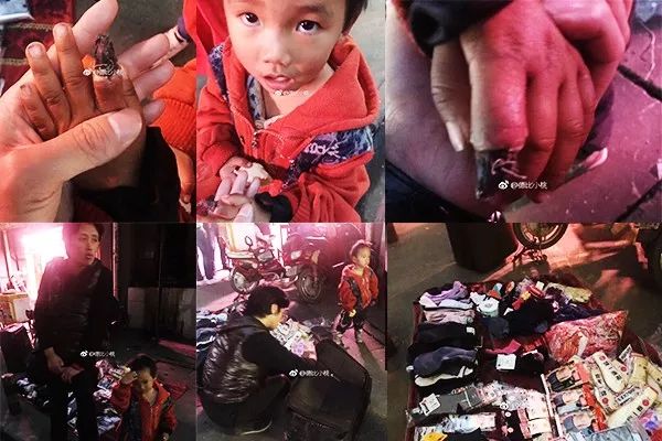 婴儿面临截肢,血泪的教训家长必知