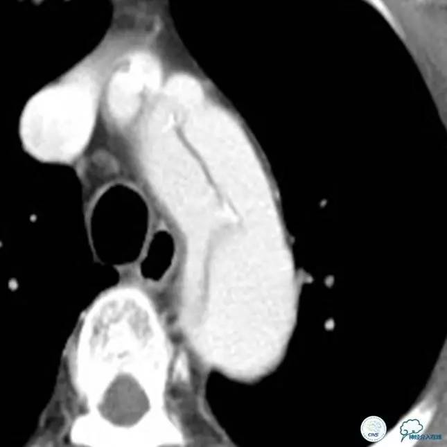 主动脉夹层引起的脑梗后遗症,颈动脉狭窄缺血性脑梗