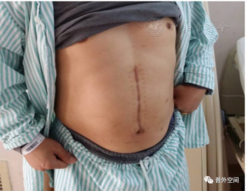 肝炎后失代偿期肝硬化的治疗与手术技巧