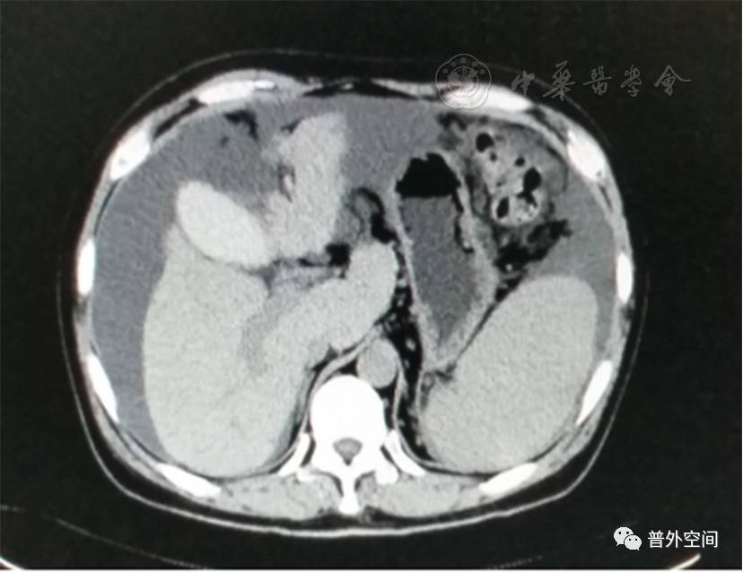 肝炎后失代偿期肝硬化的治疗与手术技巧