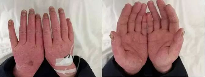 简单有效的银屑病偏方,中药泡浴治银屑病最好吗