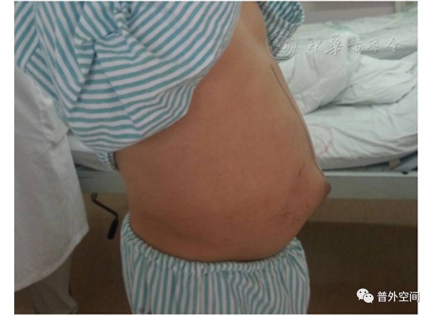 肝炎后失代偿期肝硬化的治疗与手术技巧