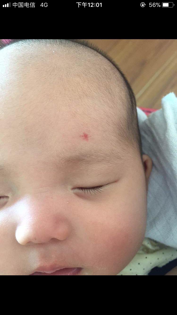 宝妈胎记,胎记你们的宝宝有吗