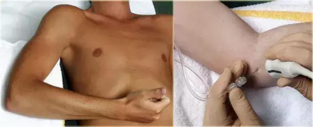 超声引导下穿刺手法解析,超声介入穿刺和普通穿刺的区别