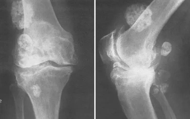 穿好奶奶织的毛裤，你仍然无法避免与风湿膏药共度晚年