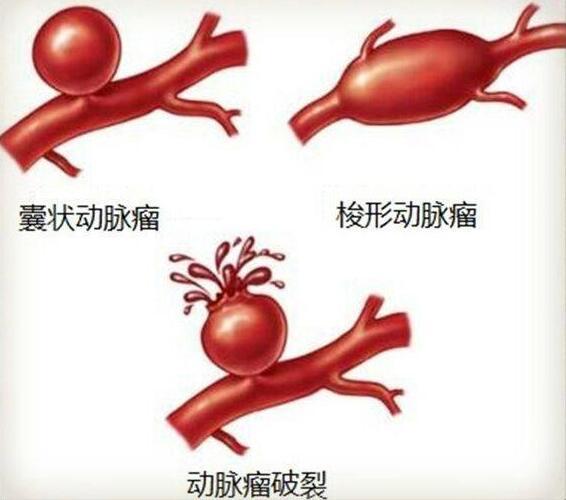 颅内动脉瘤破裂后死亡率,动脉瘤和脑肿瘤哪个严重
