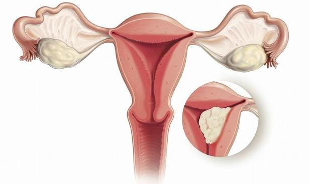 就医搜｜流产后难怀孕？别让流产为你的健康埋下“定时*弹炸**”！