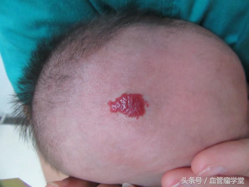 口服普萘洛尔治疗血管瘤的副作用,普萘洛尔口服液能治疗血管瘤吗