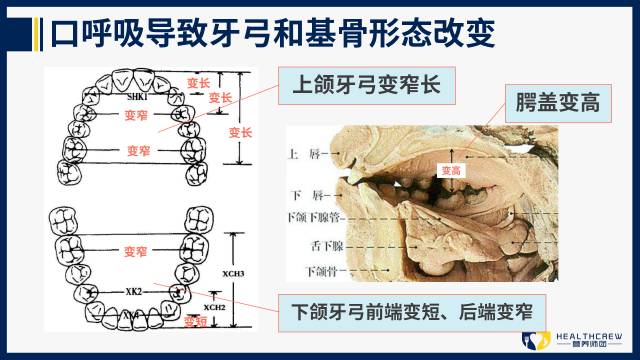 张着嘴巴睡觉会变成什么样,张着嘴睡觉会长成什么样