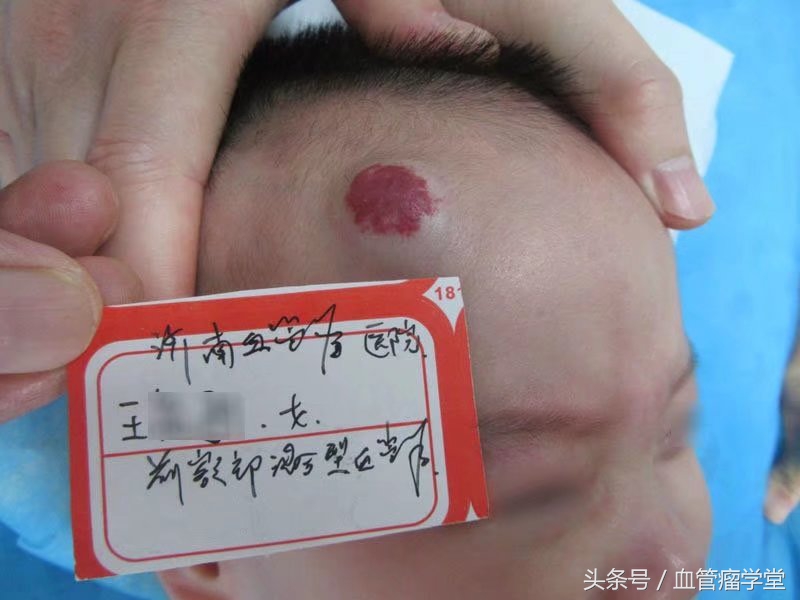 口服普萘洛尔治疗血管瘤的副作用,普萘洛尔口服液能治疗血管瘤吗