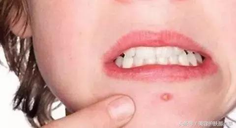 内分泌失调下巴长痘吃什么药调理,内分泌失调和下巴长痘的中药配方