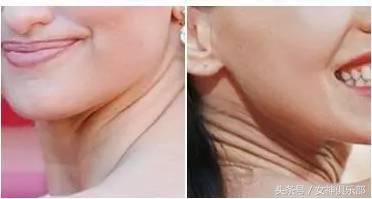 王小骞脖子颈纹很深怎么消除,儿童颈纹很深怎么消除