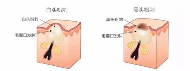 闭口怎么破？看完这篇不困惑