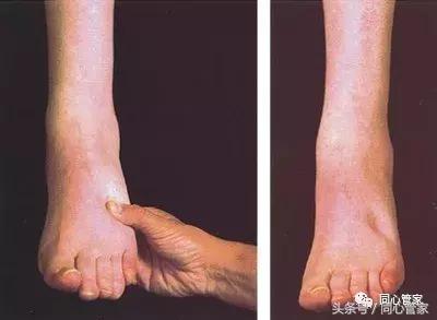 髂动脉支架术后都有什么症状,心脏支架术后最常见的9大症状