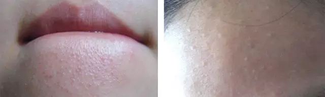 闭口怎么破？看完这篇不困惑