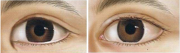 开内眼角攻略,开内眼角都需要了解哪些方面