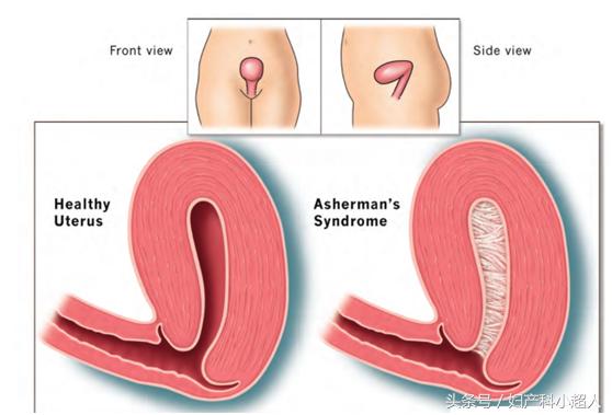 反复人工流产的危害出乎你的想象,人工流产的真实经历和感悟