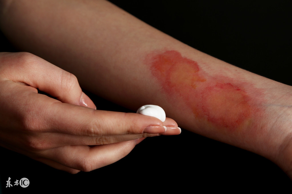 烫伤好了怎么知道留不留疤痕,烫伤后怎知道会不会起泡