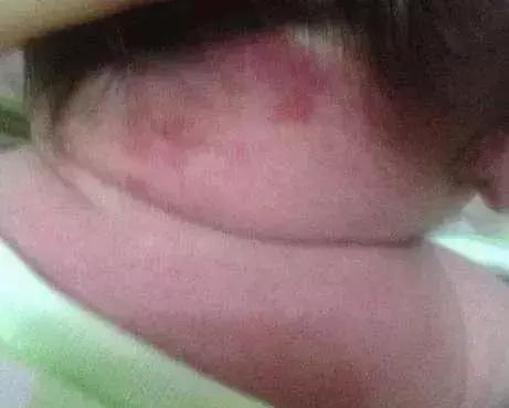 宝宝身上隐藏的“胎记”，你或许还没有发现