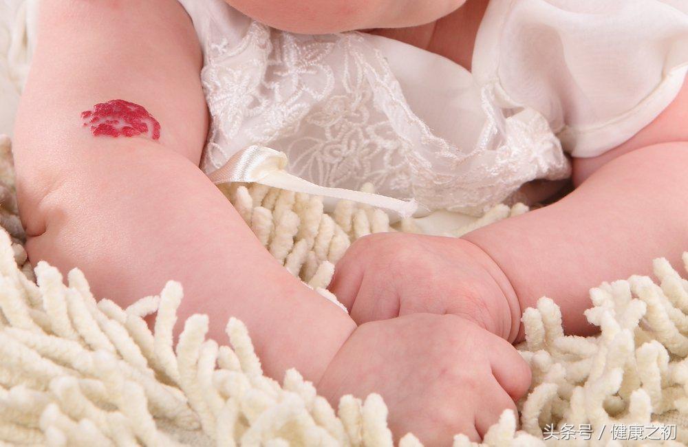 鼻子长血管瘤怎么消除,肝血管瘤消除最快方法