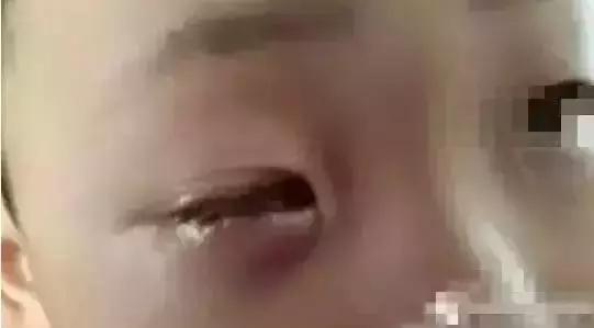 男童眼睛20分钟眼球被溶解,孩子眼球不谨慎被溶解视频谣言