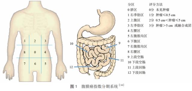 结直肠癌腹膜转移诊治中国专家意见（2017）
