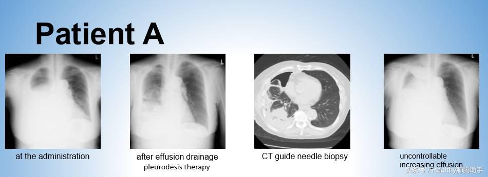 肺癌胸腔积液缓解办法,肺癌出现胸腔积液怎么治疗