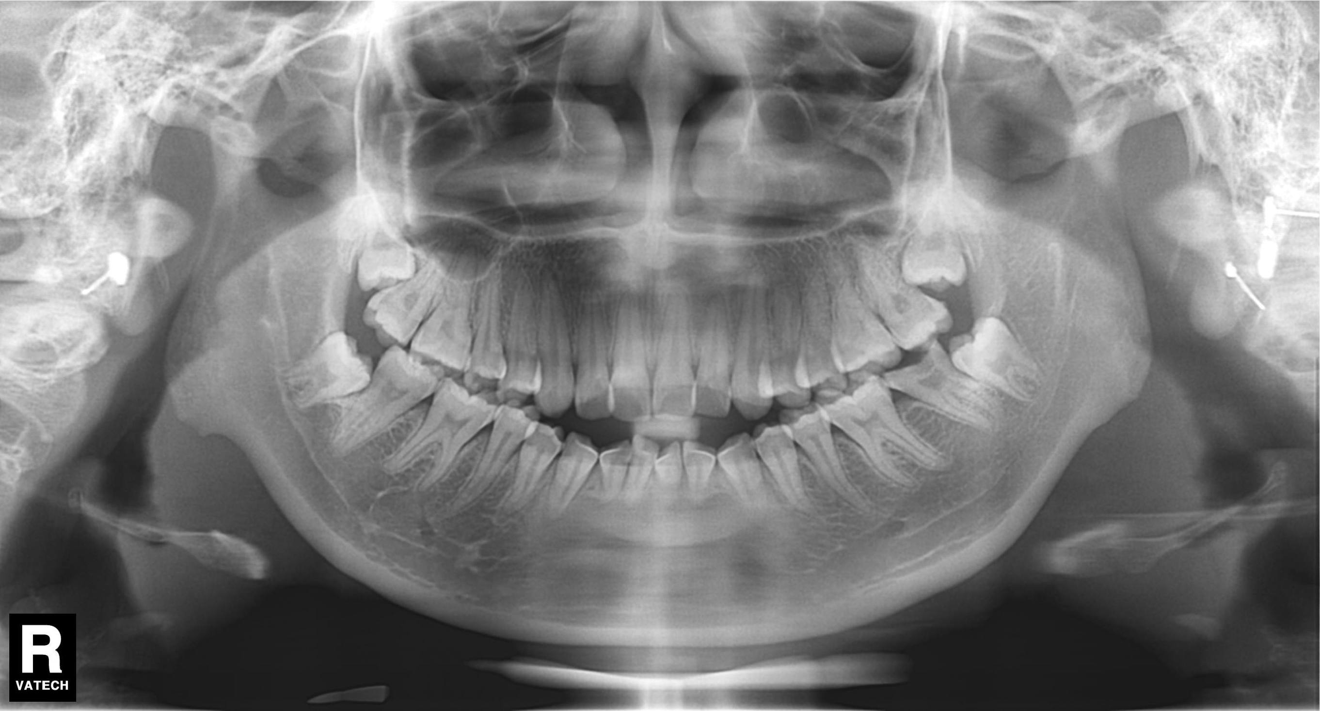 智齿长歪了把邻牙挤坏了,智齿挤歪了会自己恢复吗