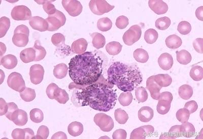 慢粒不转阴意味有复发危险吗,慢粒治疗不理想只能换药吗