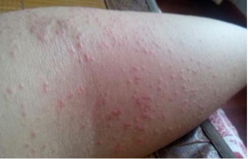 孕期胆汁淤积症和湿疹怎么区分,宝宝起湿疹是孕期乱吃的原因吗