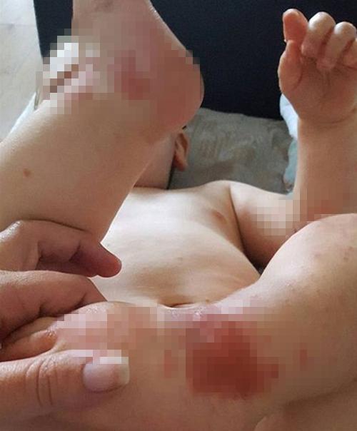 一岁宝宝起毒疙瘩正常吗,小孩身上出毒疙瘩怎么办