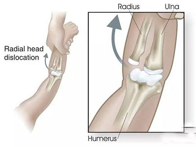 小儿桡骨半脱位的症状,小儿桡骨半脱位临床表现