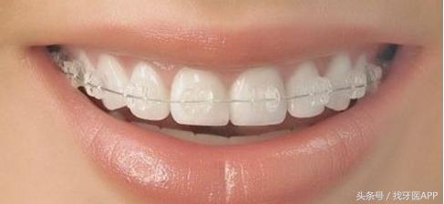 牙齿矫正能不能只矫正一半的牙齿，矫正牙齿能不能只做半口